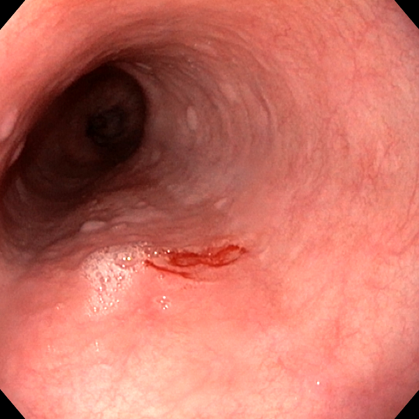 Endoscopic Image