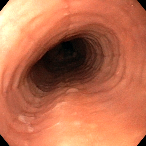 Endoscopic Image